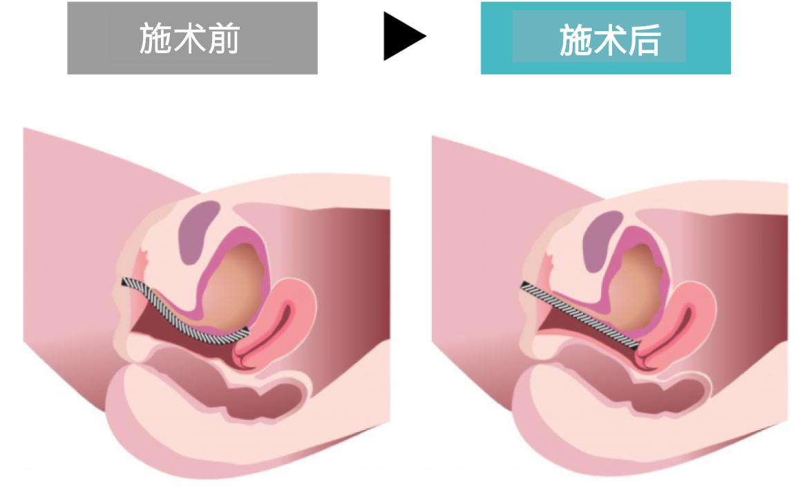 小阴唇 